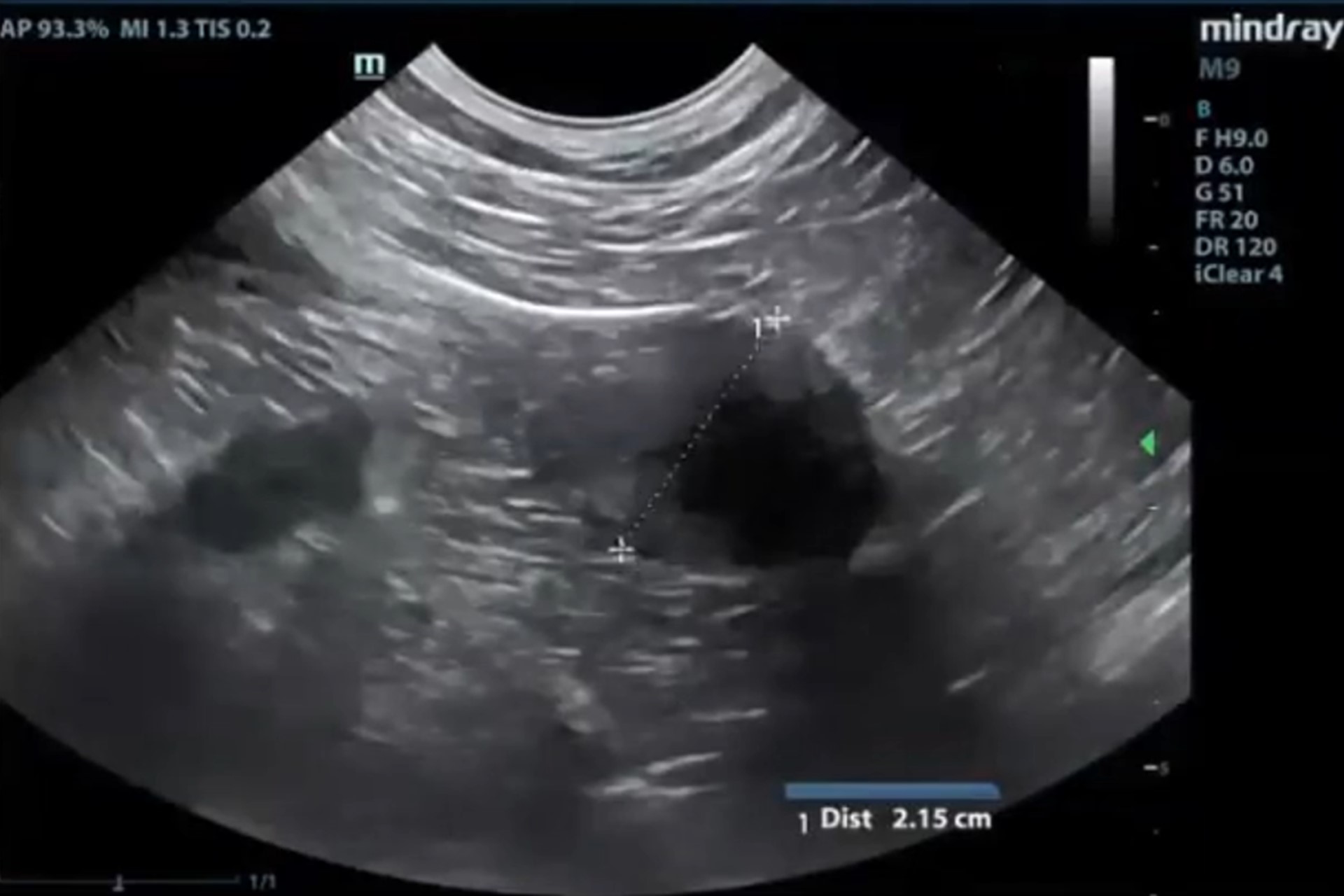 Ecografía Abdominal