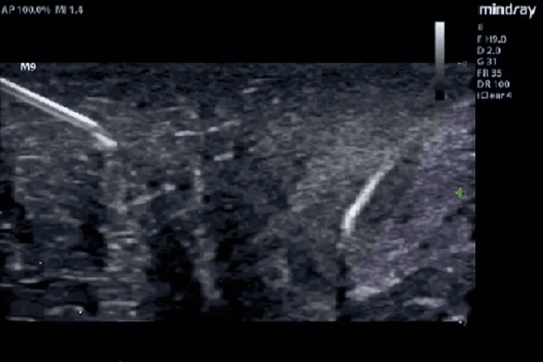 Intervencionismo ecoguiado ecorvet 2